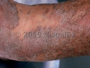 Clinical image of Non-AIDS Kaposi sarcoma - imageId=989053. Click to open in gallery.  caption: 'A close-up of extensive scaly, violaceous plaques.'