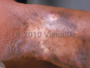 Clinical image of Lymphangiosarcoma