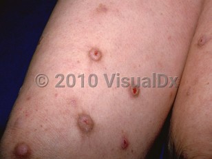 Clinical image of Prurigo nodularis - imageId=99506. Click to open in gallery.  caption: 'A close-up of scaly, pink nodules with central crusts and brown borders.'