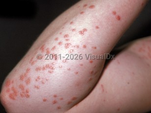 Eruptive xanthoma