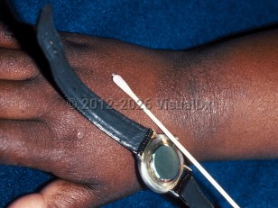 Allergic contact dermatitis (pediatric)