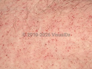 Fabry disease