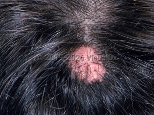 Syringocystadenoma papilliferum