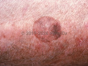 Clinical image of Large cell acanthoma - imageId=1033472. Click to open in gallery.  caption: 'A close-up of a variegated pink and brown stuck-on, wrinkled plaque.'