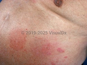 Systemic contact dermatitis