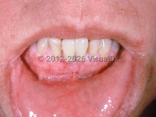 Cowden disease