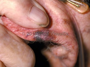 Lentigo maligna melanoma