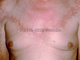 Generalized granuloma annulare