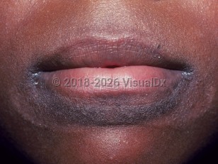 Lip-licking dermatitis