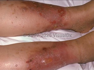 Stasis dermatitis
