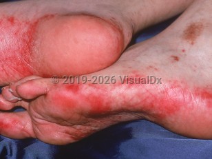 Clinical image of Acral erythema - imageId=1101276. Click to open in gallery.  caption: 'Brightly erythematous patches on the soles and lateral foot, secondary to doxorubicin.'