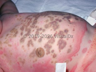 Serum sickness-like reaction
