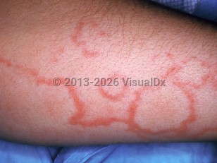 Clinical image of Erythema marginatum - imageId=1120099. Click to open in gallery.  caption: 'A close-up of annular and gyrate erythematous plaques with faint surrounding pink-orange patches.'