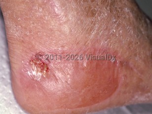 Pseudoporphyria