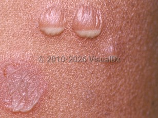 Subcorneal pustular dermatosis