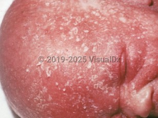 Clinical image of Leiner disease - imageId=1167751. Click to open in gallery.  caption: 'Diffuse erythema and overlying flaky scale on the face and ear.'