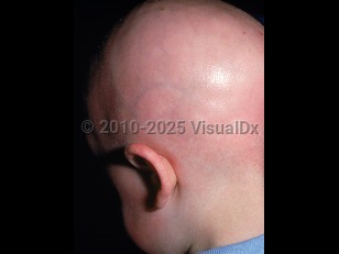 Clinical image of Keratosis follicularis spinulosa decalvans - imageId=1169189. Click to open in gallery.  caption: 'Diffuse scarring alopecia of the scalp with patchy erythema of the scalp, ear, and cheek.'
