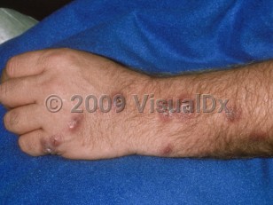 Clinical image of Sporotrichosis - imageId=117226. Click to open in gallery.  caption: 'Lymphocutaneous sporotrichosis, showing crusted and scaly erythematous nodules in a curvilinear configuration (following lymphatics), on the hand and arm.'