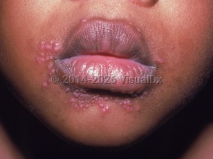 Periorificial dermatitis of childhood