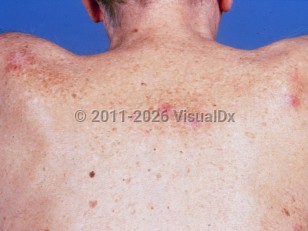 Chronic lymphocytic leukemia