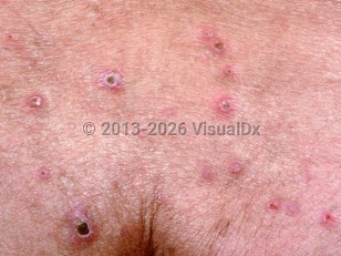 Clinical image of Reactive perforating collagenosis - imageId=1278595. Click to open in gallery.  caption: 'A close-up of numerous erythematous papules with central thick crusts.'