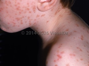 melanotic freckle   Freckles Oral pigmented lesions: Clinicopathologic features