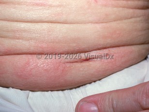 Clinical image of Diffuse cutaneous mastocytosis - imageId=1325657. Click to open in gallery.  caption: 'Edematous skin with a peau d'orange appearance and overlying urticarial plaques on the abdomen.'