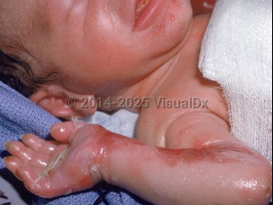 Generalized severe epidermolysis bullosa simplex