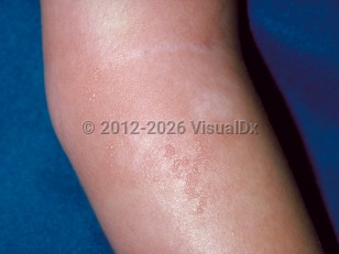 Eosinophilic cellulitis