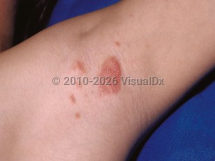 Clinical image of Inverse psoriasis - imageId=14015. Click to open in gallery.  caption: 'Well-demarcated, salmon-pink papules with scant scale and a similar plaque in the axilla.'