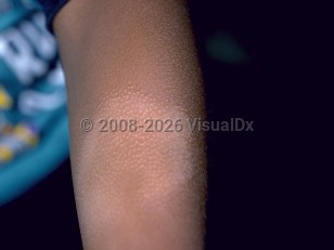 Pityriasis alba