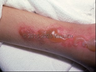 Coma bullae