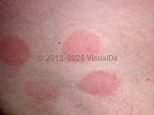 Allergic contact dermatitis