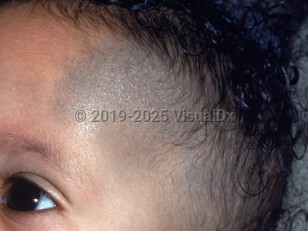 Nevus of Ota