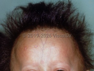 Clinical image of Progeria - imageId=1473531. Click to open in gallery.  caption: 'A large cranium, frontal bossing, loss of subcutaneous fat, and sparse eyebrows.'