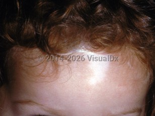 Waardenburg syndrome