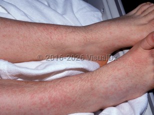 Clinical image of Adenovirus infection - imageId=1504256. Click to open in gallery.  caption: 'Diffuse faint pink macules, papules, and plaques on the legs and feet.'