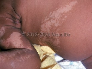 Hypomelanosis of Ito