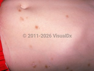 Clinical image of Toxocariasis - imageId=1534666. Click to open in gallery.  caption: 'Hyperpigmented macules on the abdomen and flank.'