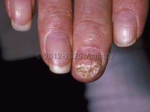 Onychomycosis