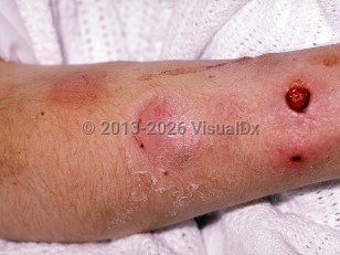 Skin bacterial abscess