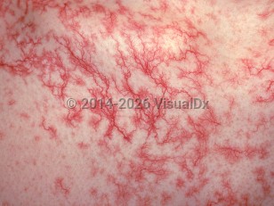Clinical image of Generalized essential telangiectasia - imageId=1544705. Click to open in gallery.  caption: 'A close-up of telangiectatic patches.'