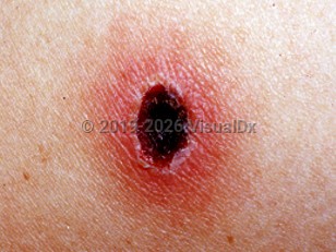 Scrub typhus