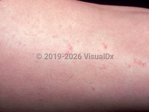 Unilateral nevoid telangiectasias