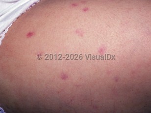 Aplastic anemia