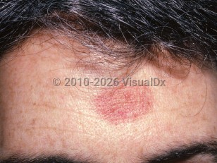 Traumatic purpura