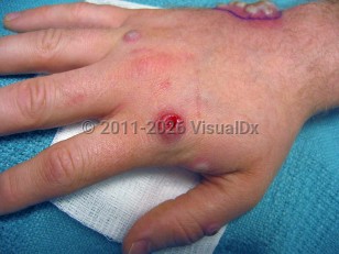 Mpox