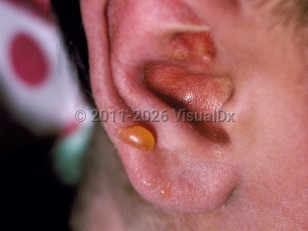 Acute graft-versus-host disease