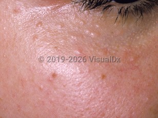 Syringoma