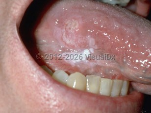 Oral squamous cell carcinoma